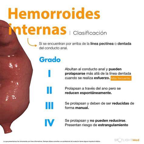 fotos reales de hemorroides|Tipos de hemorroidas com fotos